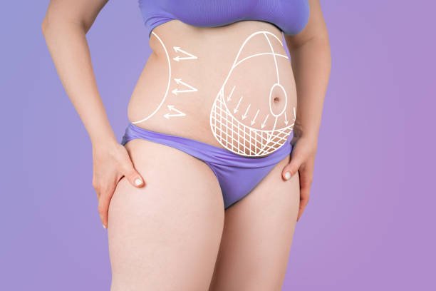 Enhanced Body Confidence with 360 Liposuction